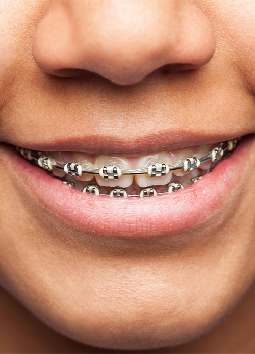 Traditional Metal Braces