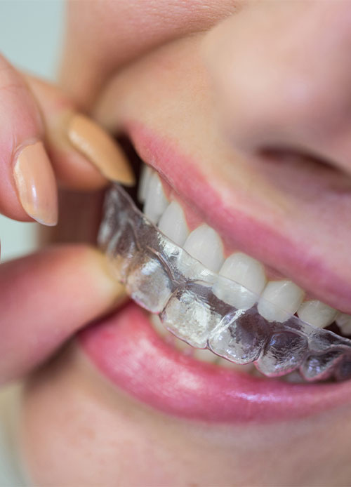 Clear Aligners